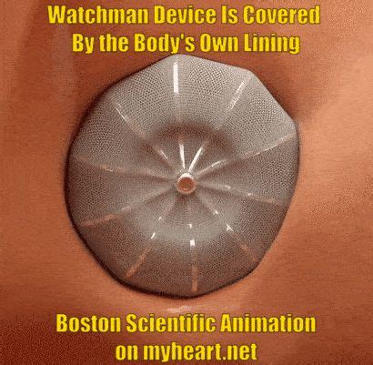 watchman-procedure-8-device-endothelialization | Cardiologist, Watchmen ...