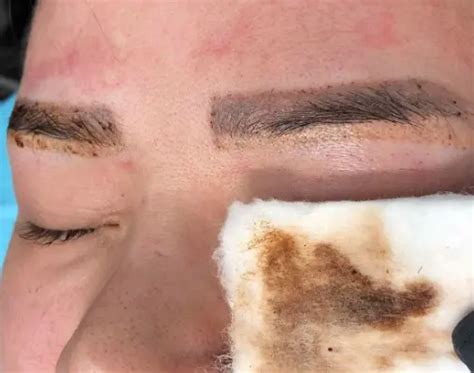 EYEBROW TATTOO REMOVAL: HOW DOES IT WORK
