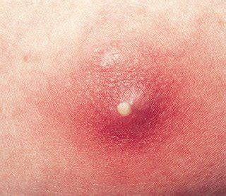 Boils And Skin Infections - Stamford Skin Centre