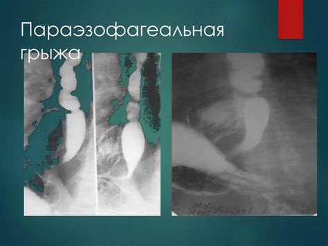 Грыжи живота. Осложненные грыжи. Диагностика и хирургическая тактика ...