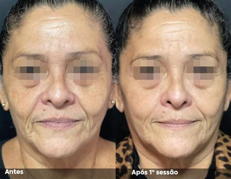 Hifu Antes E Depois - Hipro - A revolução do ultrassom microfocado (HIFU)