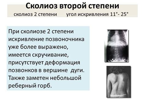 Сколиоз 1, 2 и 3 степени: берут ли в армию, когда дают отсрочку
