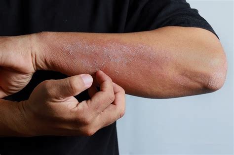 xerosis gejala penyebab  pengobatan alodokter