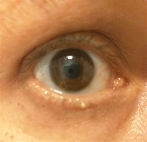 Just got this cyst, what do you suggest? : r/popping