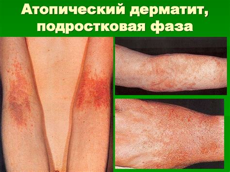 Аллергодерматозы - презентация онлайн