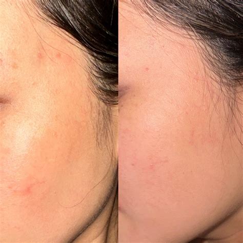 Azelaic Acid 公與 1