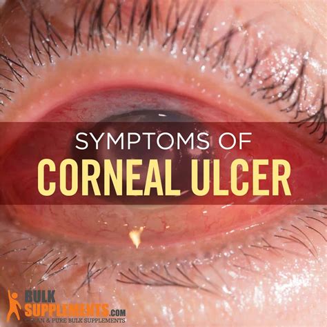 Will A Corneal Ulcer Go Away On Its Own - Infoupdate.org
