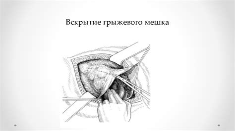 Послеоперационные вентральные грыжи. Сепарационная герниопластика ...