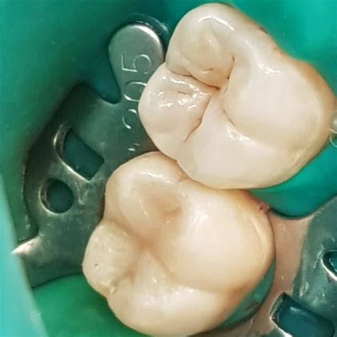 Лечение кариеса зубов в клинике у Просвещения в Выборгском р-не СПб