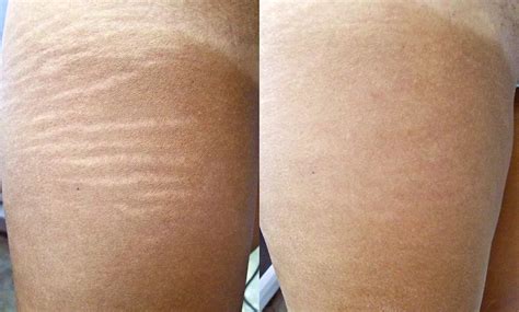 skinly aesthetics stretch marks treatments explained