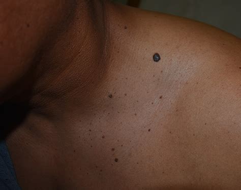 Seborrheic Keratosis (SK) | School of Medicine