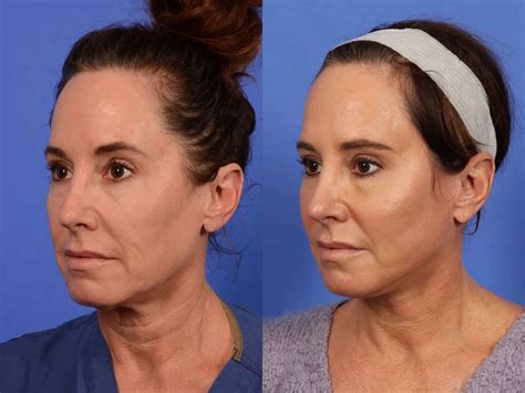 Facelift Before & After Photos | W Cosmetic Surgery