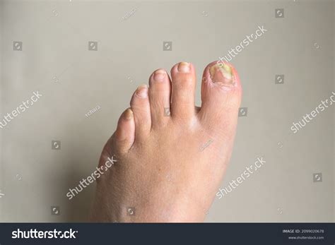 how to know if toenail is infected
