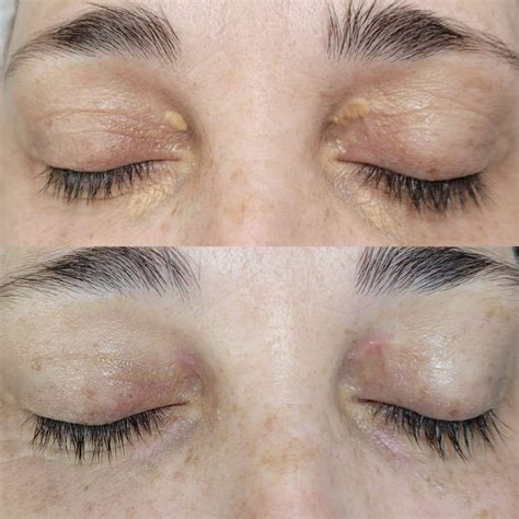 Aplicação De Enzimas Antes E Depois 9