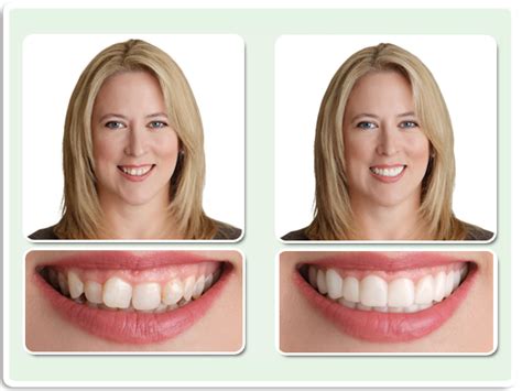 Snap-On Smile ️ κριτικές, απάτη; οδηγιεσ χρησησ, φαρμακειο, Skroutz