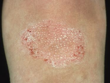 Pityriasis Rubra Pilaris Pathology