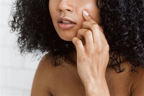 The Grossest (and Most Satisfying) Pimple Pop Ever