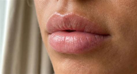 dark lips treatment  hyderabad lip laser cost