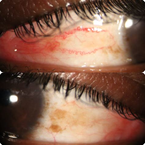 Eye Pain? – 88 Optometry