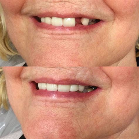 Memphis Dentures and Implants