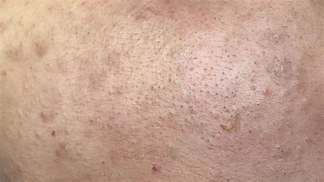 Blackheads Under The Skin | Mụn Đầu Đen Dưới Da - SacDepSpa#301