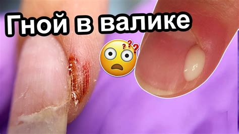 Воспаление После Маникюра 😱 Панариций | Причины и Лечение | Обработка ...