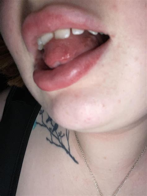 Burning sensation on tongue and white patches/sore : r/askdentists