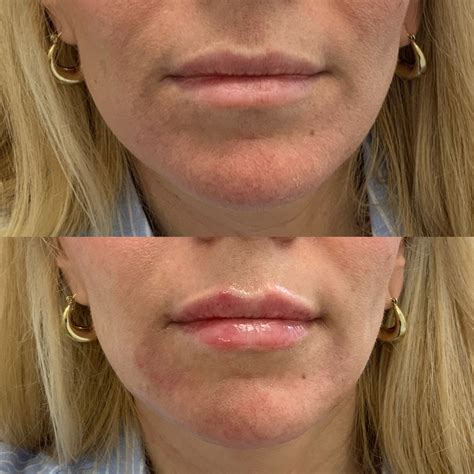 Botox Lip Flip Vs. Lip Filler: Everything You Need To Know | Defy