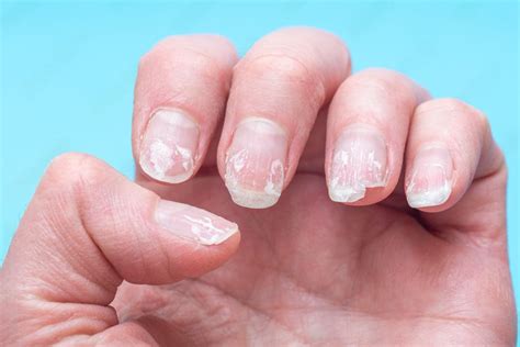 Почему слоятся ногти - мнение эксперта сети студий CITY NAILS