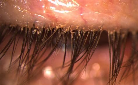 blepharitis scope connect