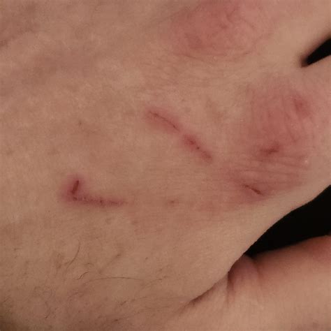 These scrapes on the back of my hand look like a triangle. : r