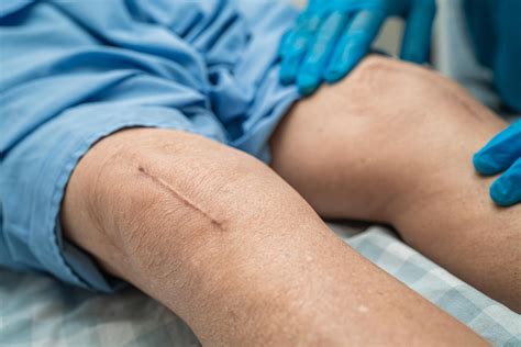 OLD SCARS LIMITING YOUR MOVEMENTS? - ycrehab