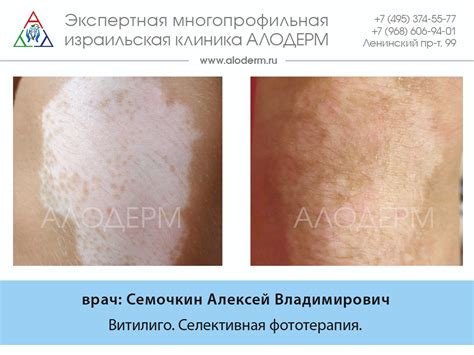 Лечение витилиго - Нефтекамск | Клиника АЛОДЕРМ