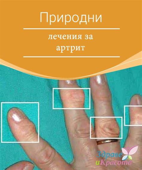 Природни лечения за артрит | Salud, Pinterest