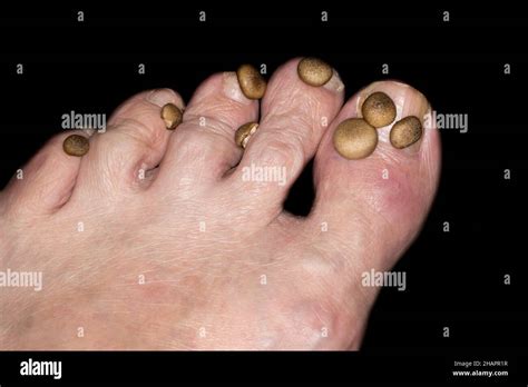 Tinea unguium pedis hi-res stock photography and images - Alamy