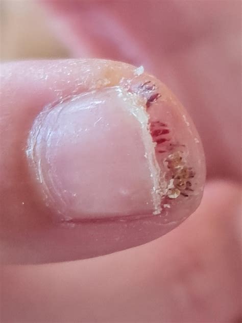 my wart turned black after a foot injury? what does that mean? it hurt