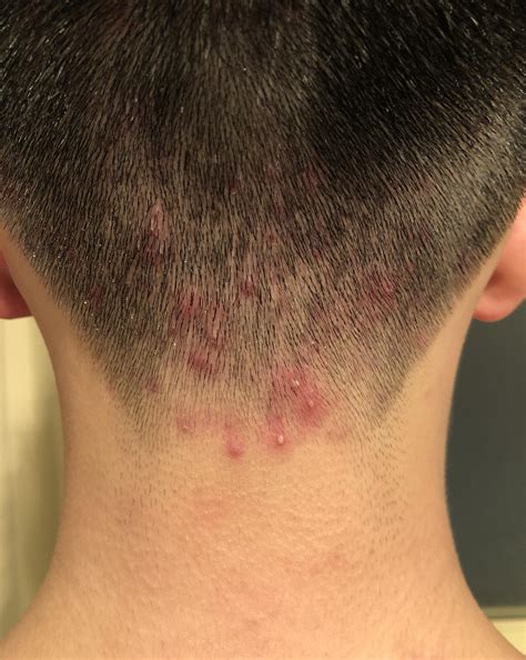 Scalp Folliculitis Hair Loss