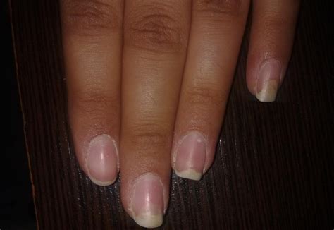 Onycholyse: Traitements pour les ongles détachés - FRMedBook