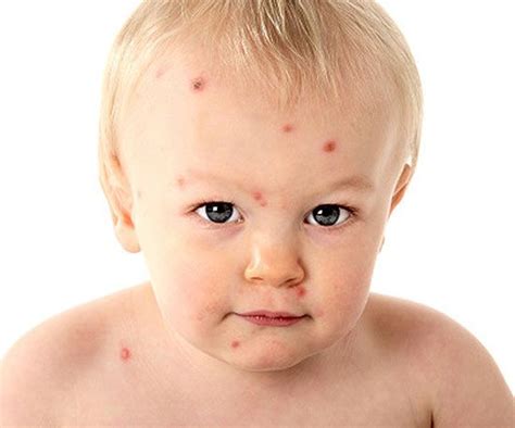 When Babies Get Chickenpox