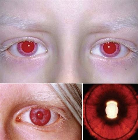 Albino Person Red Eyes