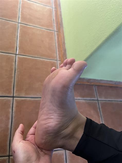Does this look like atrophy (muscle loss) in my feet? I have had muscle