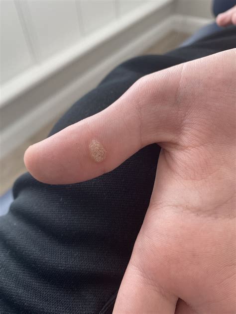 Verrucae Needling — Suzanne Hamilton Podiatry