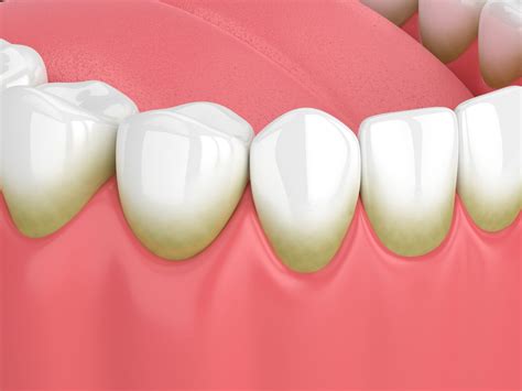 Brown Spots on Teeth (Causes, Prevention & Treatment)