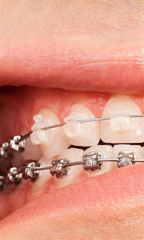 Ortodoncia: Mitos y verdades acerca - Clínica Kranion