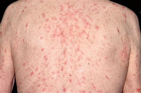 Allergic Reaction Rash From Lotion at Bernice Astle blog