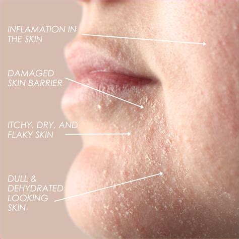 Best 12 Curezma – “Game Changing” Non-steroid Eczema Creams – Artofit