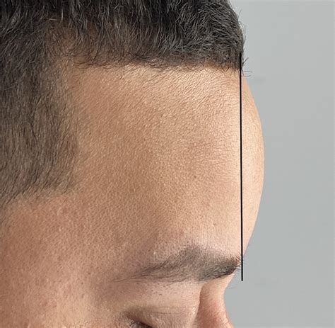 frontal bossing
