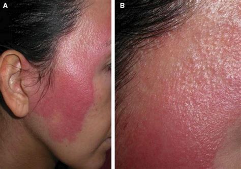 dermatologists guide   red face tash