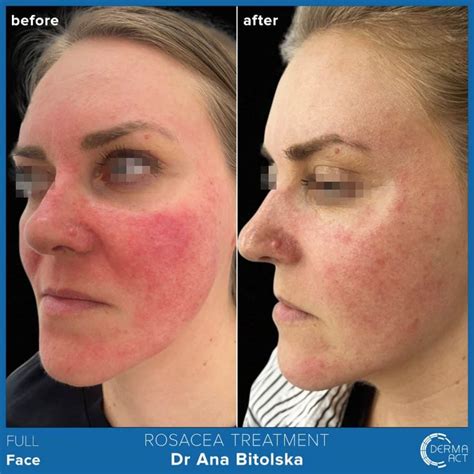 Розацея - причини, диагностика и лечение | Derma-Act