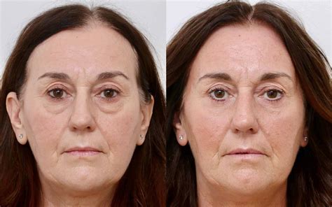 Blepharoplasty Aberdeen, Eyelid Surgery Dundee, Eye Lift Surgery
